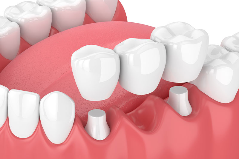 Dental Bridges in Phoenix