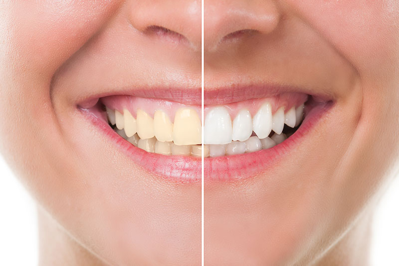 Teeth Whitening in Phoenix