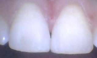 Diastema-Closure-After-Image