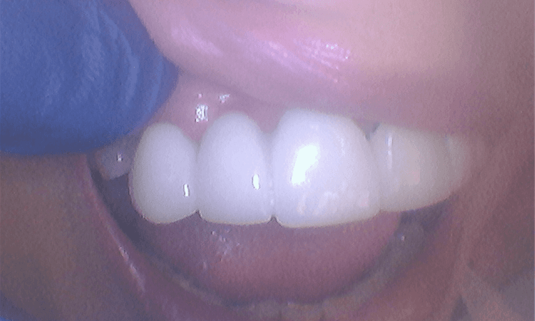 Emergency-Smile-Repair-After-Image