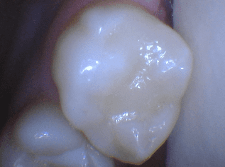 Tooth-Colored-Fillings-for-a-Natural-Looking-Tooth-After-Image