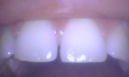 Diastema-Closure-Before-Image