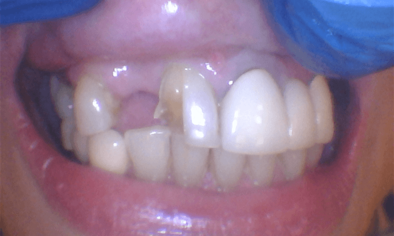 Emergency-Smile-Repair-Before-Image