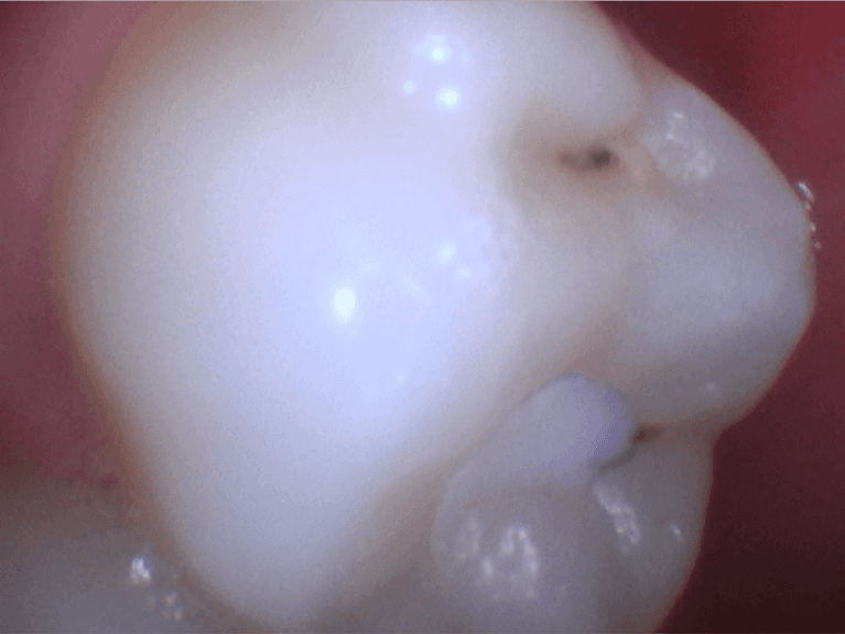 Tooth-Colored-Fillings-for-a-Natural-Looking-Tooth-Before-Image